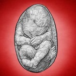 A History of Lithopedions: When a Fetus Turns to Stone