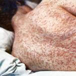 Congrats to RFK Jr., As the U.S. Is Poised to Lose Its Measles Elimination Status After 25 Years