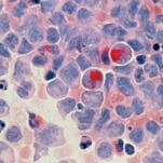 You’ve Never Been More Likely to Get Cancer, Survive Cancer, or Be Bankrupted by Cancer