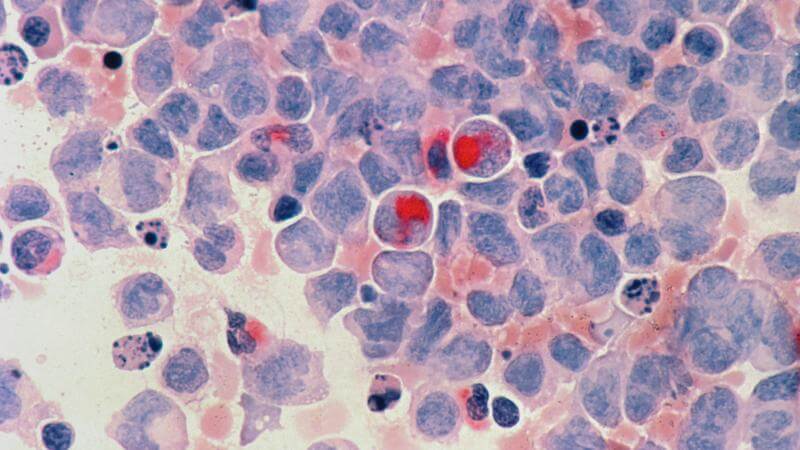 You've Never Been More Likely to Get Cancer, Survive Cancer, or Be Bankrupted by Cancer