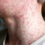 It Sure Looks Like Pretty Much Every Unvaccinated Kid Is About to Get Measles