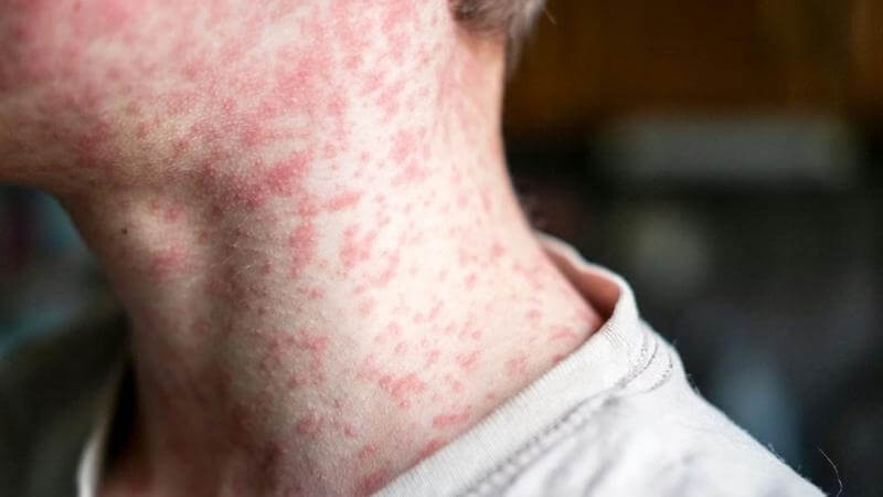 It Sure Looks Like Pretty Much Every Unvaccinated Kid Is About to Get Measles
